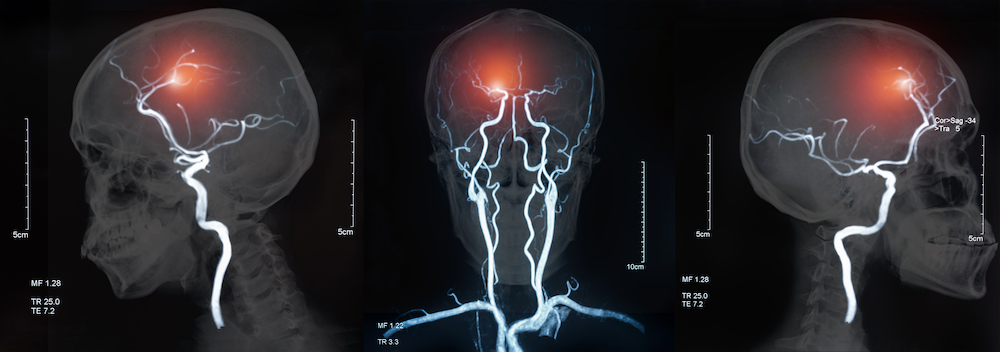 Contre une maladie du cerveau longtemps sans traitement, la recherche tient enfin des pistes