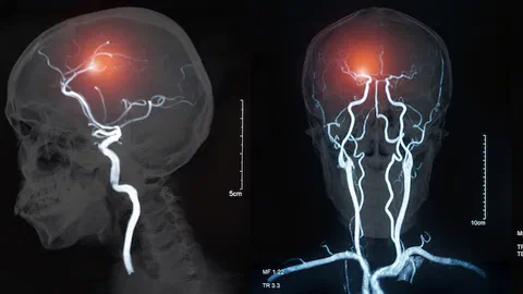 Contre une maladie du cerveau longtemps sans traitement, la recherche tient enfin des pistes