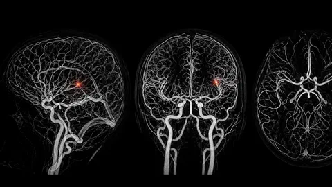 Contre une maladie du cerveau longtemps sans traitement, la recherche tient enfin des pistes