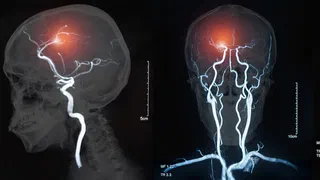 Contre une maladie du cerveau longtemps sans traitement, la recherche tient enfin des pistes