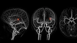 Contre une maladie du cerveau longtemps sans traitement, la recherche tient enfin des pistes